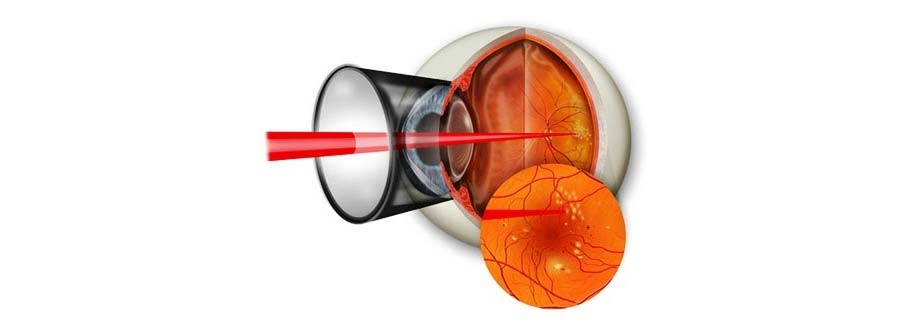 Ablacija mrežnice, retine
