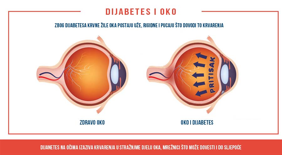Dijabetes na očima izaziva krvarenja u stražnjme djelu oka, mrežnici što može dovesti i do sljepoće